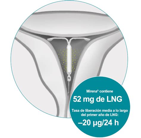 schema de funcționare a steriletului Mirena cu eliberare de levonorgestrel