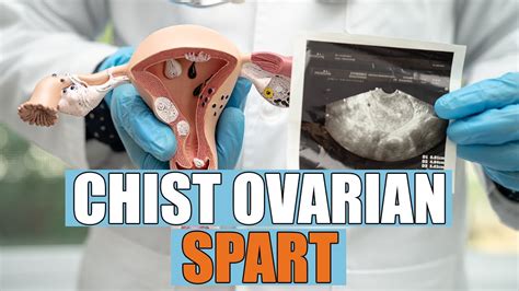 Ilustrație a unui chist ovarian.