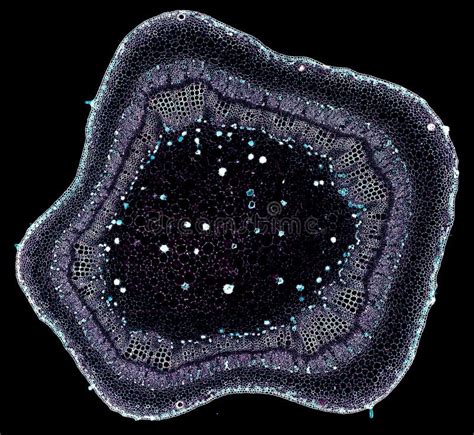 Imagine microscopică a celulelor cervicale normale și cu displazie.