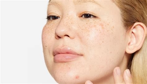 infografic cu cele mai comune modificări ale pielii în sarcină: melasma, linia nigra, vergeturi, acnee, papiloame