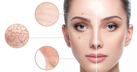 imagine cu piele uscată și descuamată, ilustrând xeroza cutanată