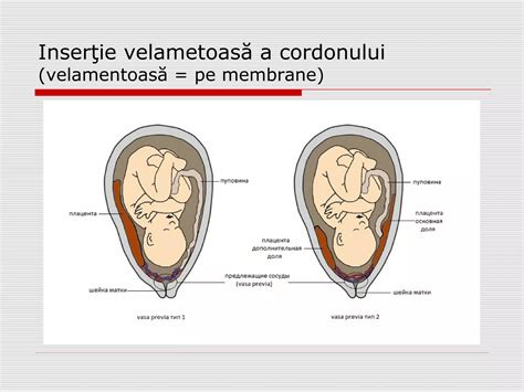 diagramă ilustrând rupturile membranelor amniotice