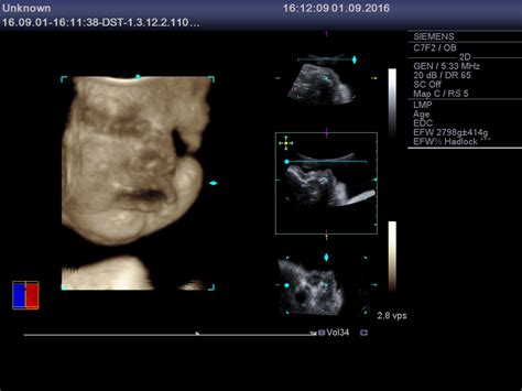 ecografie 3D cu un bebeluș