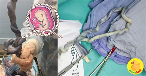 Ecografie prenatală care arată cordonul ombilical înfășurat în jurul gâtului fătului
