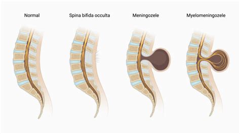 Ilustrație schematică a formării tubului neural și a defectelor asociate (spina bifida, anencefalie).