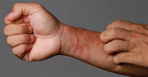 Colaj de imagini care prezintă diferitele tipuri de erupții cutanate comune la bebeluși: milia, eritem toxic, erupție la scutec, eczemă.