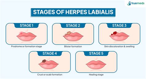 infografic cu etapele apariției herpesului oral