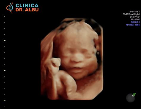 ecografie de trimestru 1