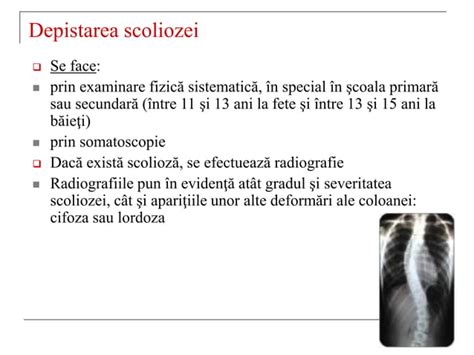 Schema explicativă a tehnicii chirurgicale de corectare a scoliozei