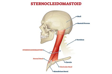 Ilustrație anatomică a mușchiului sternocleidomastoidian (SCM) și poziția capului în torticolis