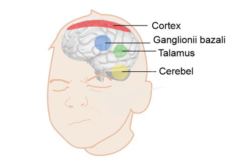 Ilustrație schematică a sindromului Tourette