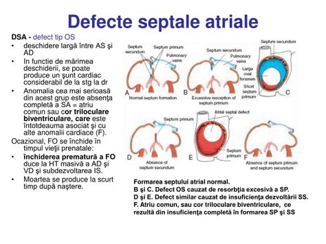 Diagramă ilustrând diferitele tipuri de defecte septale cardiace