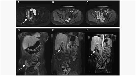 Imagine RMN a intestinului subțire, evidențiind pereții intestinali.
