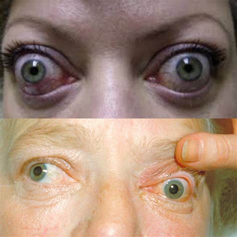 Ilustrație cu o persoană care recoltează probă de salivă cu un tampon bucal