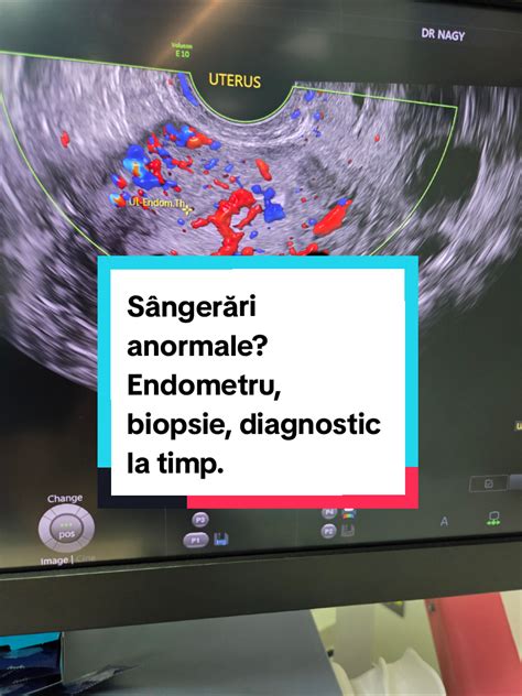 Ilustrație a implantării blastocistului în endometru.