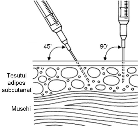 Ilustrație detaliată a modului corect de administrare a injecției subcutanate cu Prolutex