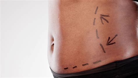 Comparație înainte și după abdominoplastie, evidențiind conturul abdominal remodelat.