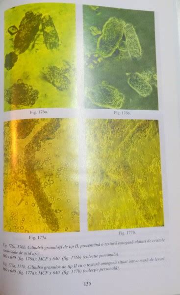 Micrografie a celulelor prezente în sedimentul urinar