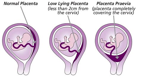 ilustrație medicală comparând placenta normală cu placenta praevia și abrupția placentară