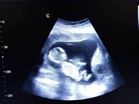 ecografie fetală în săptămâna 13-15 de sarcină