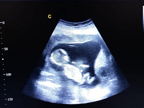 ecografie fetală în săptămâna 22-33 de sarcină