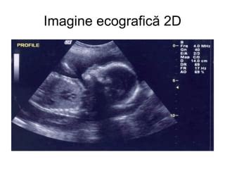 Imagine ecografică cu translucența nucală