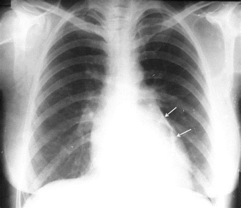 Radiografie toracică neonatală care arată pneumotorax