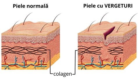 Infografic: Cum apar vergeturile în sarcină și zonele afectate