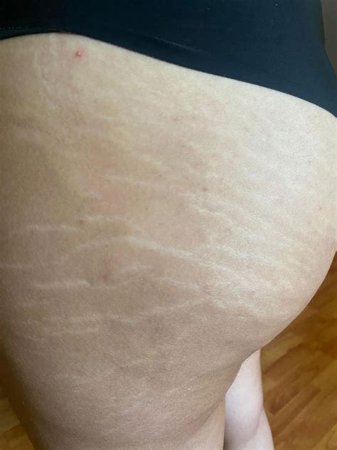 Comparație: Eficacitatea diferitelor tipuri de tratamente pentru vergeturi