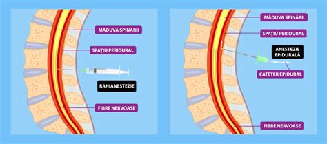 Infografic explicativ despre tipurile de anestezie: spinală, epidurală și generală.