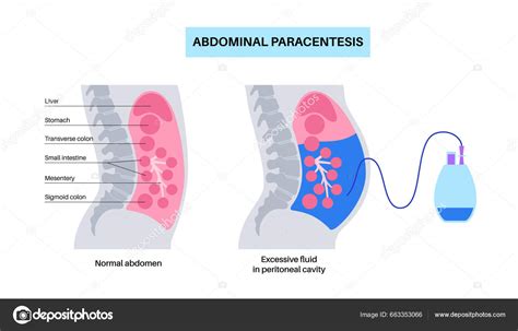 Ilustrație a unui abdomen destins, cu săgeți indicând zonele de disconfort.