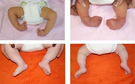 copil cu picior strâmb tratat prin metoda Ponseti