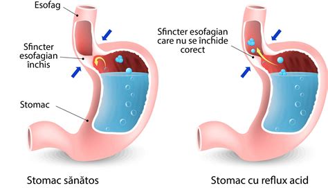 Ilustrație anatomică a esofagului și stomacului, cu accent pe sfincterul esofagian inferior.