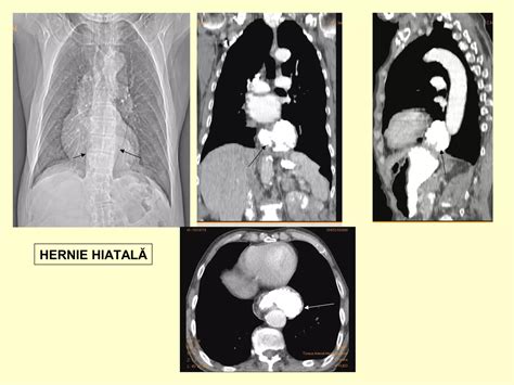 imagini endoscopice cu esofagită sau hernie hiatală