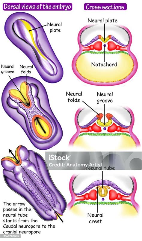 ilustrație care arată dezvoltarea tubului neural la făt și posibilele defecte