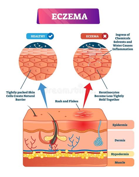Ilustrație comparativă a texturii suzetei din latex și a mamelonului mamei