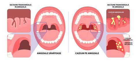 Ilustrație cu simptomele amigdalitei: gât roșu, amigdale umflate cu puncte albe, febră