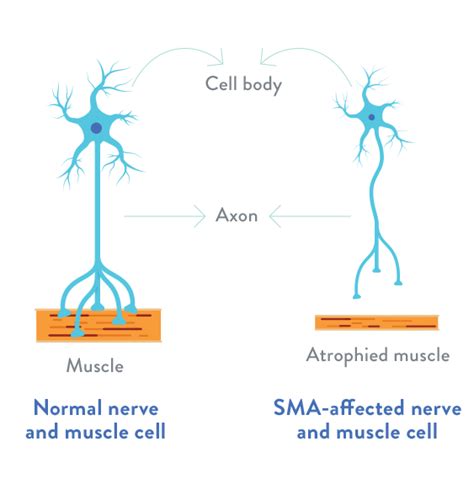 ilustrație medicală care prezintă afectarea neuronilor motori în atrofia musculară spinală