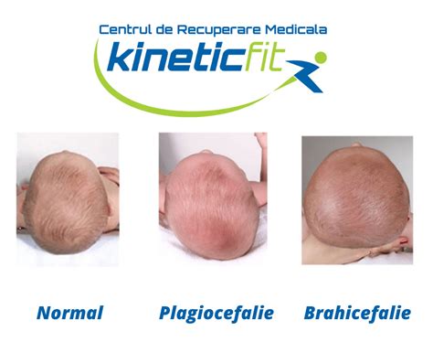 Ilustrație comparativă: un cap normal și un cap cu plagiocefalie, subliniind asimetria