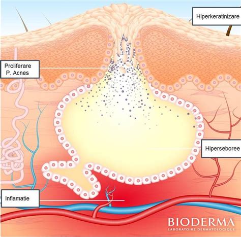 Schema procesului de formare a leziunilor acneice, evidențiind blocarea foliculului pilosebaceu cu sebum și celule moarte, multiplicarea bacteriană și inflamația.