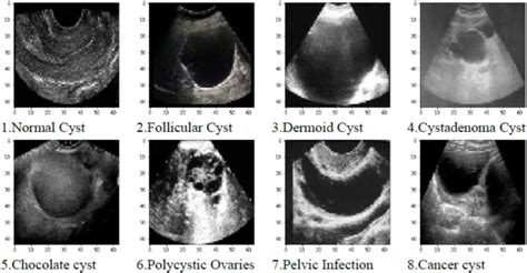 ilustrație comparativă a diferitelor tipuri de chisturi ovariene