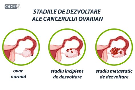 Ilustrație a unei tumori ovariene