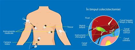 Infografic comparativ între colecistectomia laparoscopică și cea deschisă