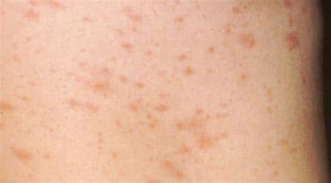 Ilustrație a leziunilor de pitiriazis rozat dispuse în forma de 