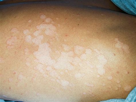 Imagine cu pete decolorate specifice pitiriazisului versicolor pe trunchi.