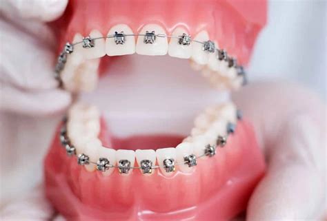 planșă cu secțiuni transversale ale dinților și aparat dentar