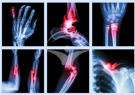 Imagine radiologică a unei fracturi de bazin