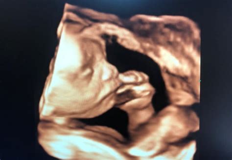 Ecografie fetală 3D cu vizualizarea feței copilului