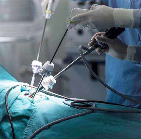 Ilustrație a poziționării trocarelor pentru chirurgia laparoscopică a herniei ombilicale.