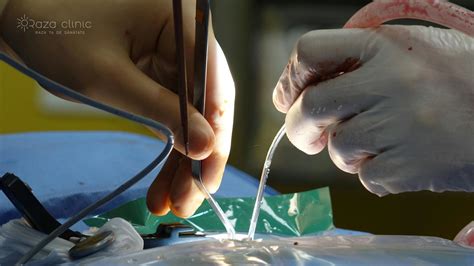 Ilustrație schematică a unei proceduri chirurgicale minim invazive la copii